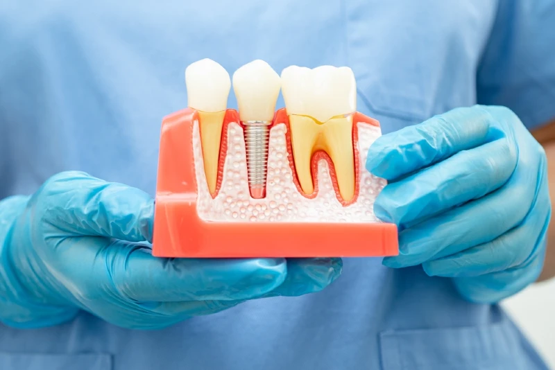 All-on-4 All-on-6 Dental Implants